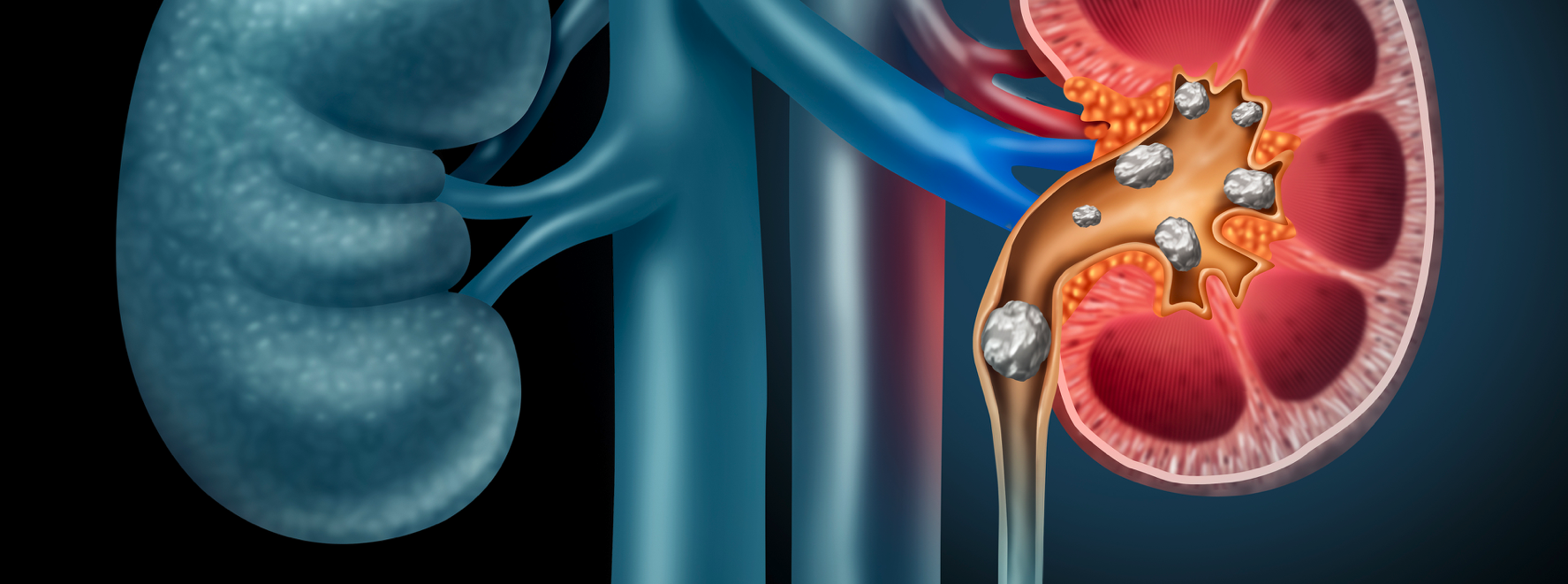When Are Kidney Stones a Red Flag? Alnylam® Newsroom